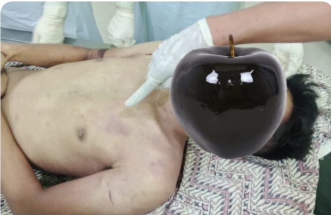 DIDUGA DIANIAYA OLEH OKNUM APH HINGGA TEWAS, KEMATIAN M. AL-Farizi di Laporkan Ke Polda Aceh